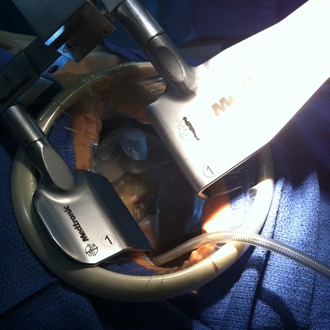 1376-c-215-mics-thorax