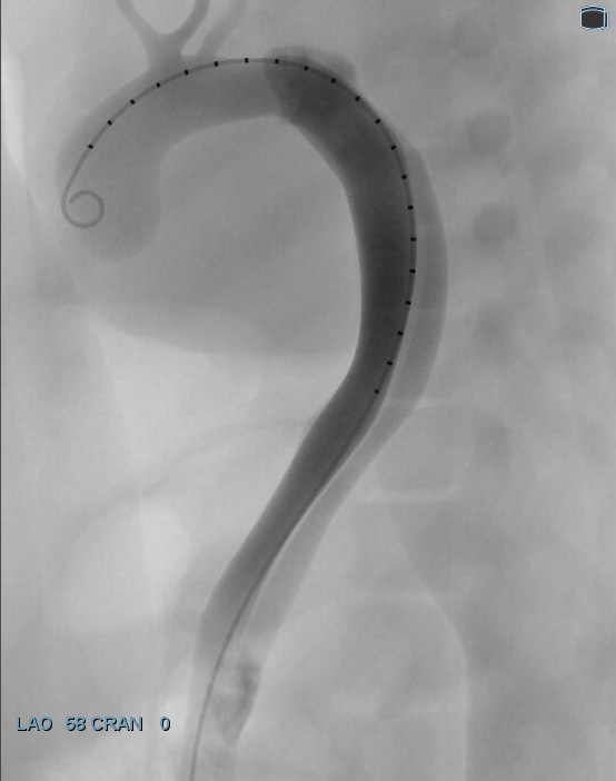 acute-dissection
