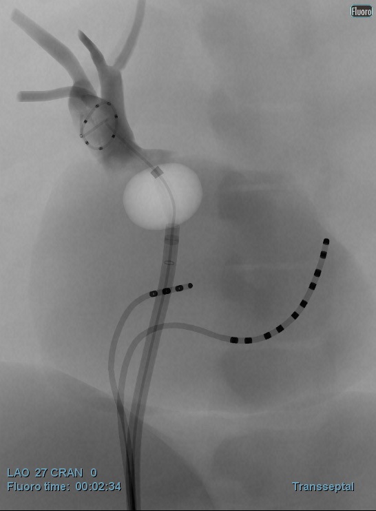 af-ablation