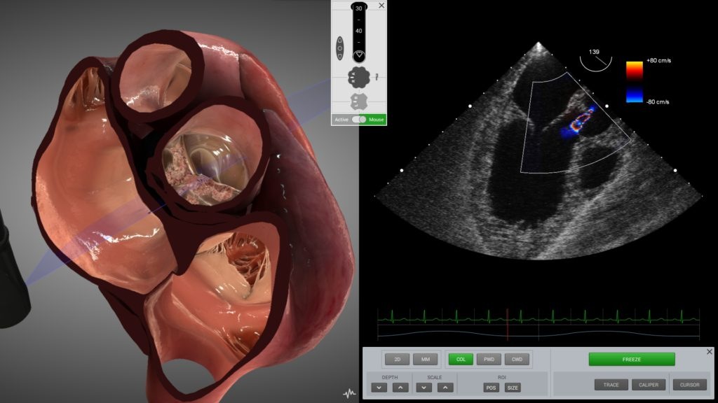 aortic-regurg-tee-2