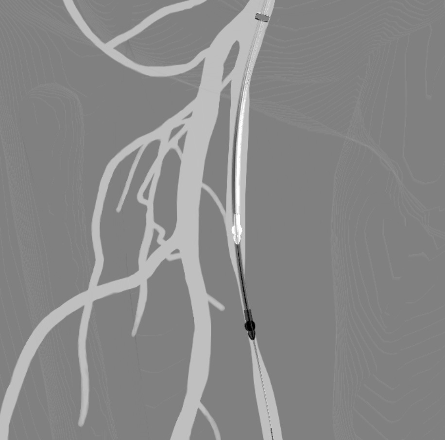 atherectomy