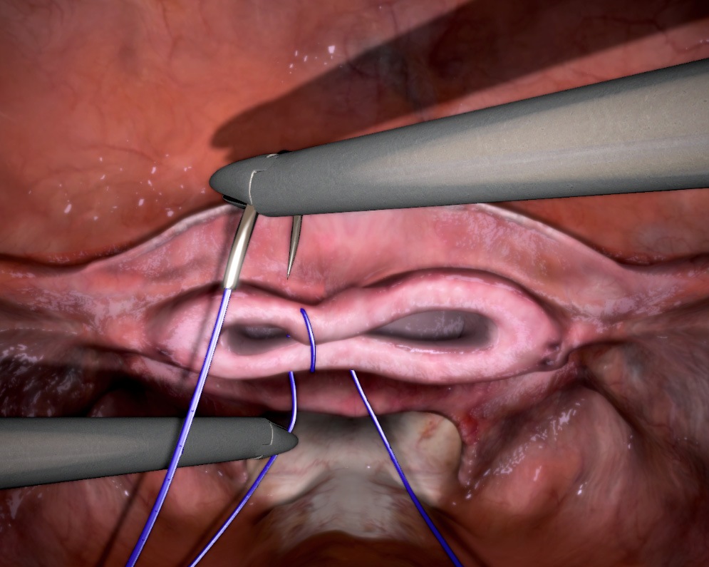 bidirectional-case
