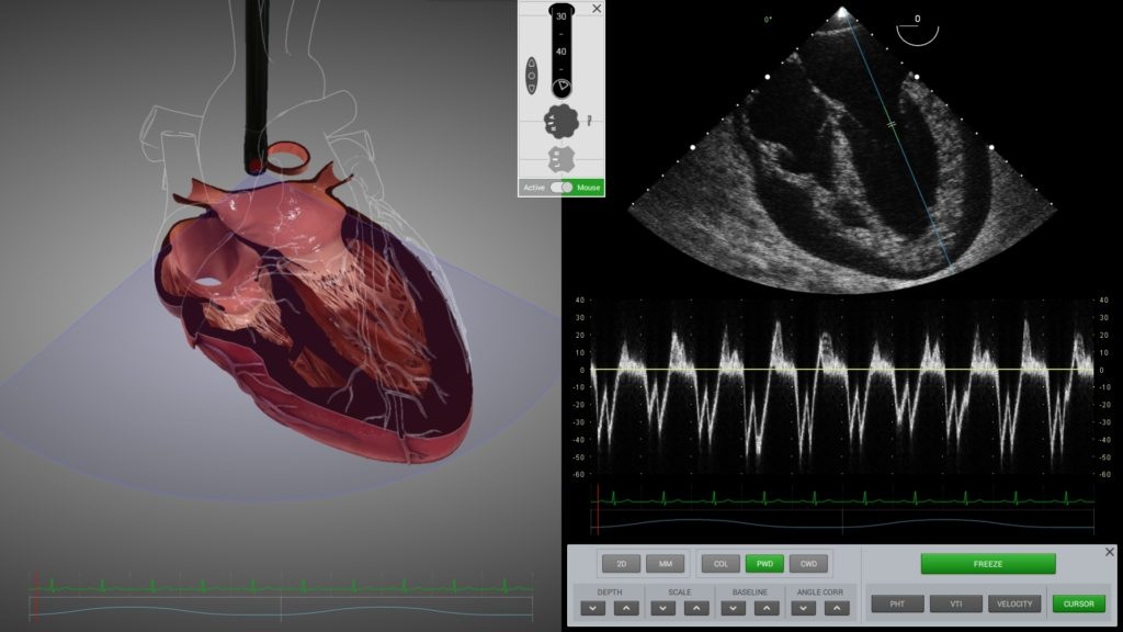 cardiac-tamponade-tee-1