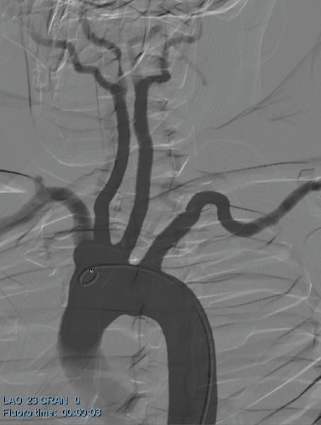 carotid