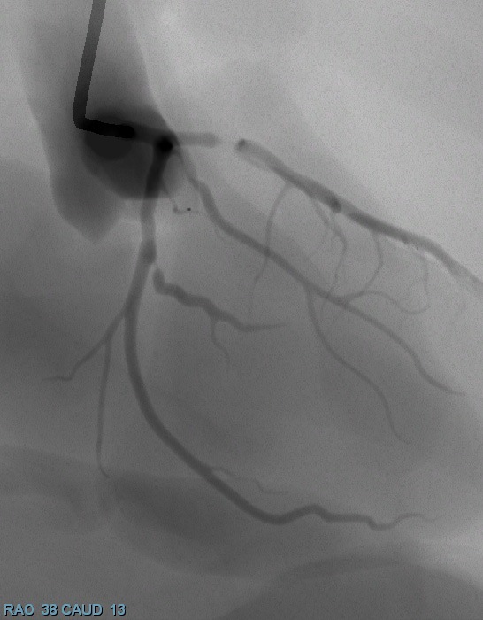 coronary