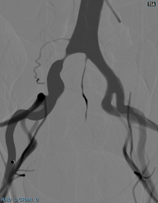 iliac