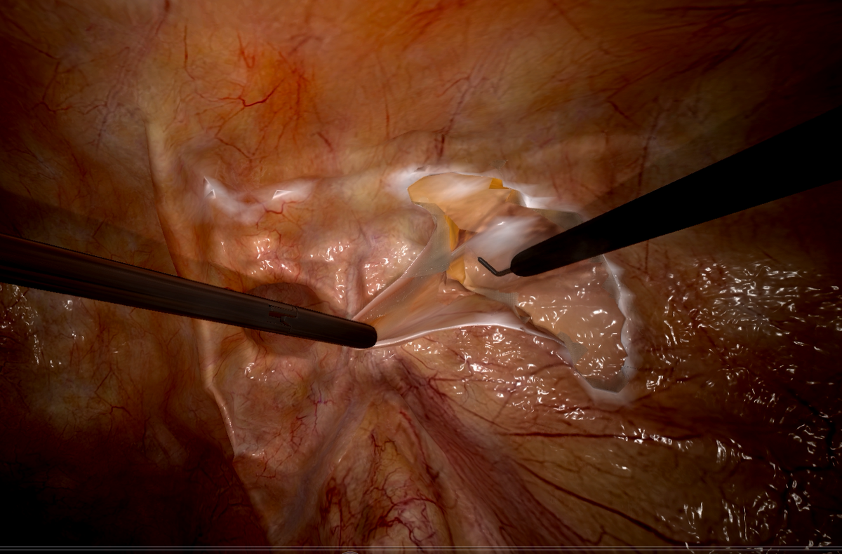 inguinal-hernia-1