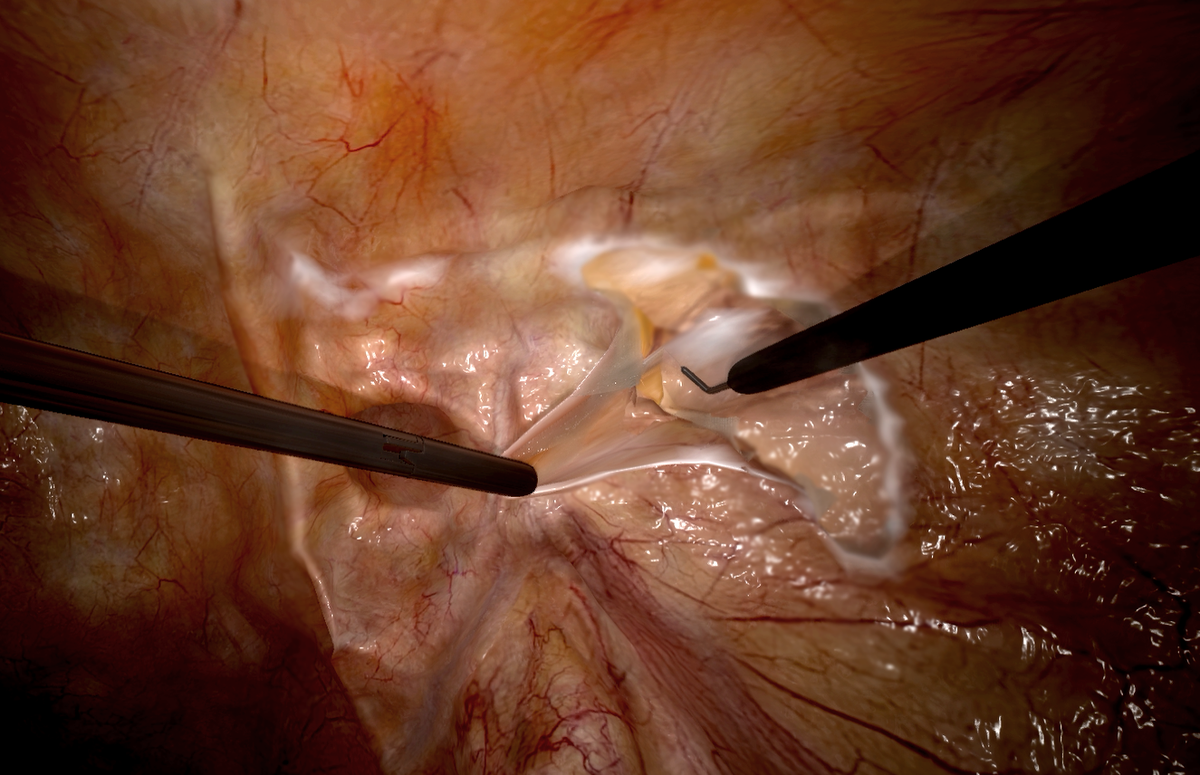 inguinal-hernia