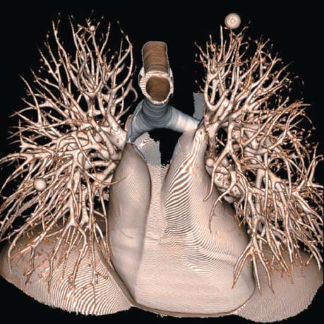 lung1-3d