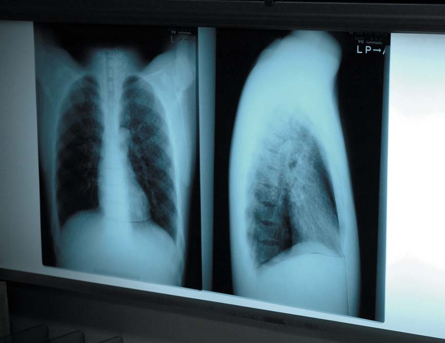 lung2-xray-review1