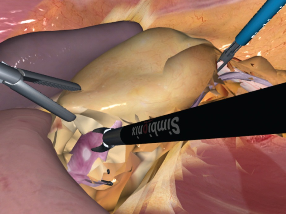 nephrectomy