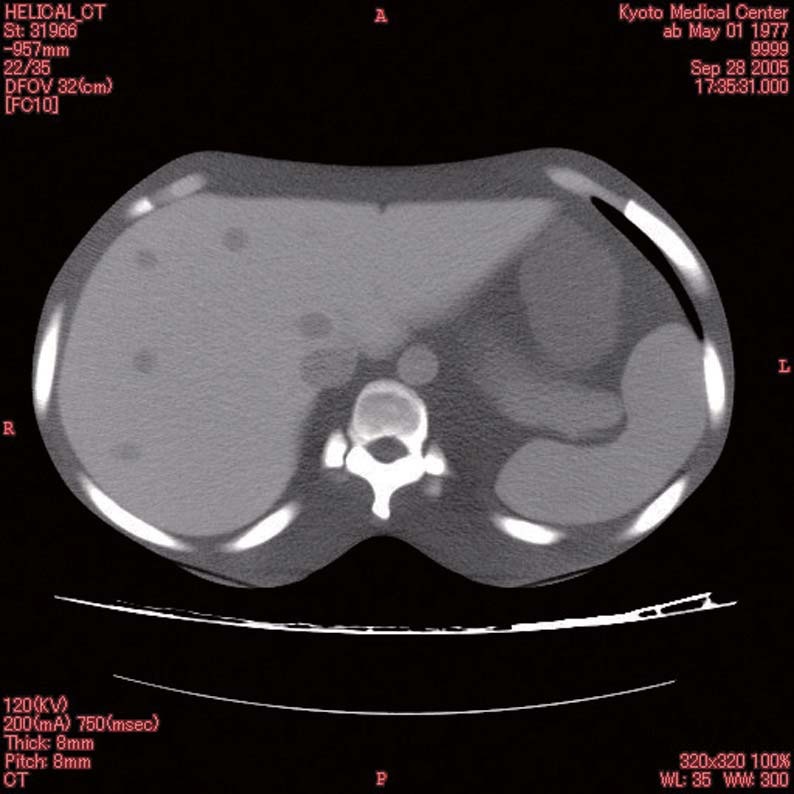 ph-5abdomen-ax1