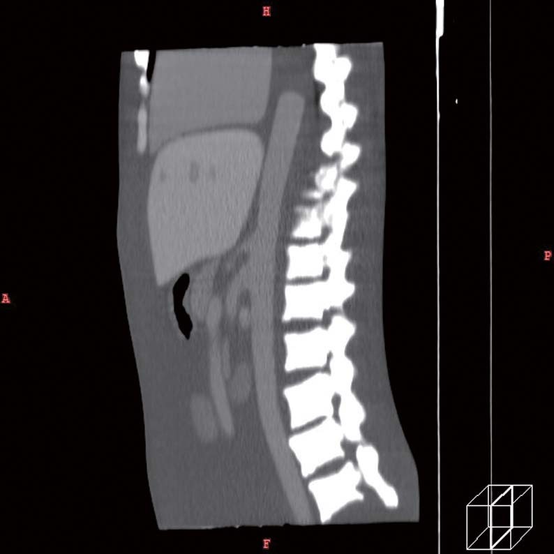 ph-5abdomen-sagi