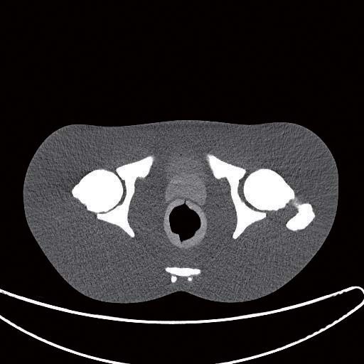 ph46prostate-ct2
