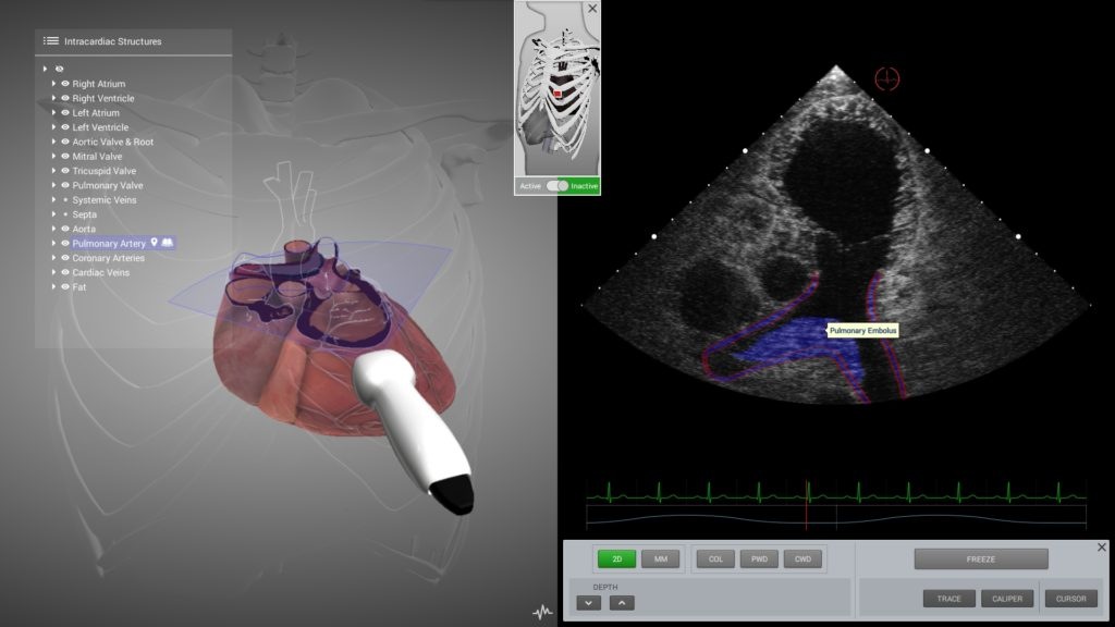 pulmonary-embolism-tte-1