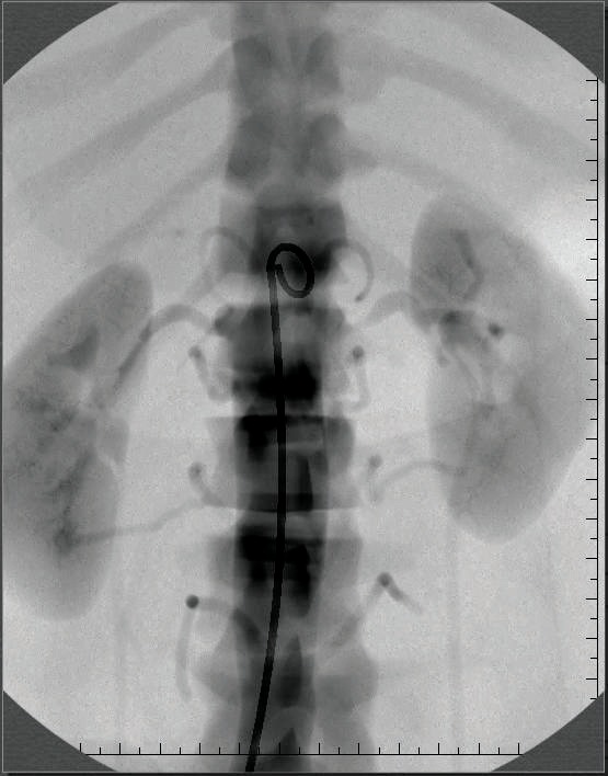renal