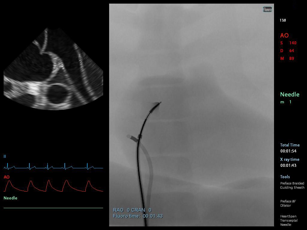 transseptal