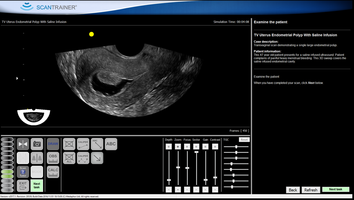 tvs-endo-polyp-l