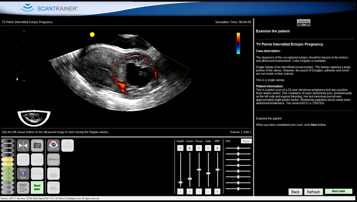tvs-endo-polyp-with-colour-l