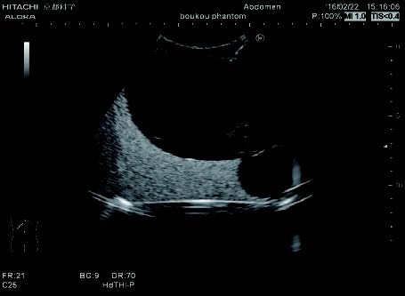 urinary-retention
